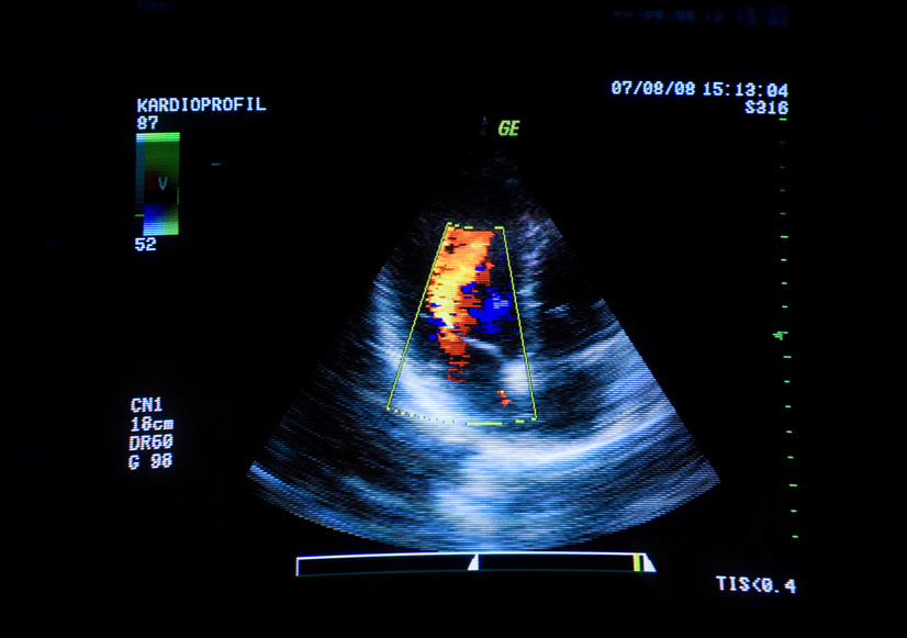 Heart ultrasound image on computer screen.